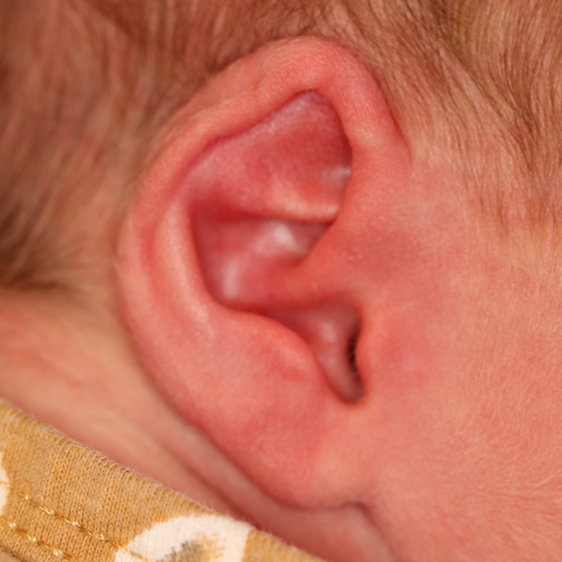 Close up of an infant's ear before EarWell Infant Ear Molding at Carson Williams Facial Plastic Surgery in Leawood, KS