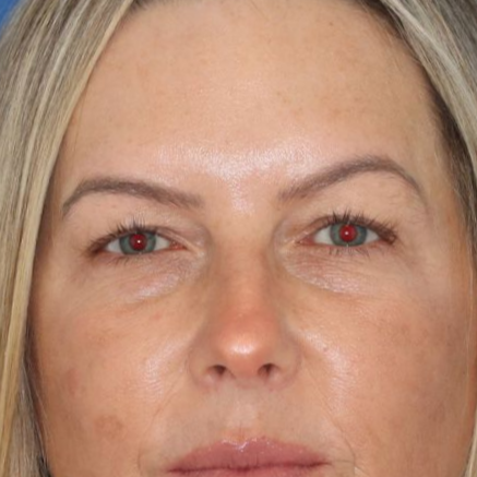 Woman posing for before photos for blepharoplasty surgery