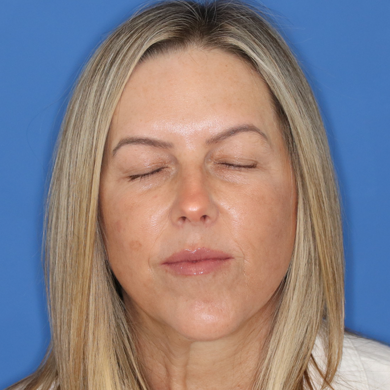 Woman before eyelid surgery on a blue background