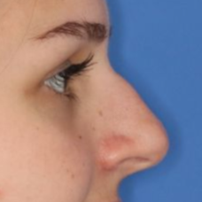 Close up of a female's nose before undergoing a liquid rhinoplasty