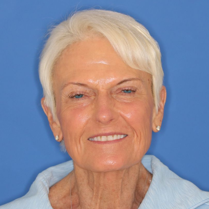 Close up of woman's face after CO2 laser treatment at Carson Williams MD Facial Plastic Surgery