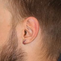 An after  picture of a man who underwent Earlobe Repair at Carson Williams MD Facial Plastic Surgery office in Leawood KS