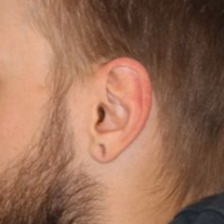 A before picture of a man who underwent Earlobe Repair at Carson Williams MD Facial Plastic Surgery office in Leawood KS
