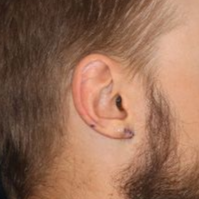 An after  picture of a man who underwent Earlobe Repair at Carson Williams MD Facial Plastic Surgery office in Leawood KS