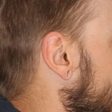 A before picture of a man who underwent Earlobe Repair at Carson Williams MD Facial Plastic Surgery office in Leawood KS