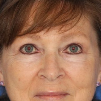 58 year old man who underwent bilateral upper blepharoplasty in office under local anesthesia