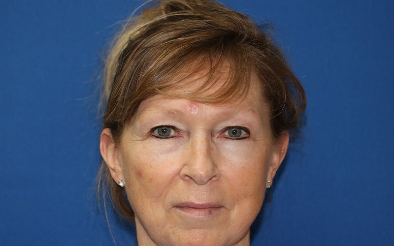 58 year old man who underwent bilateral upper blepharoplasty in office under local anesthesia