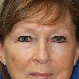 58 year old man who underwent bilateral upper blepharoplasty in office under local anesthesia