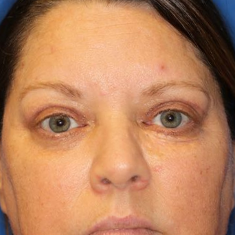 55 year old female who underwent bilateral upper blepharoplasty under local anesthesia in office