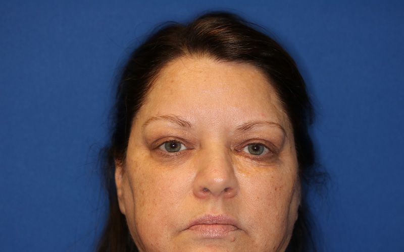 55 year old female who underwent bilateral upper blepharoplasty under local anesthesia in office
