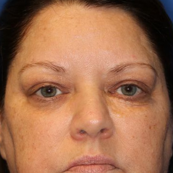 55 year old female who underwent bilateral upper blepharoplasty under local anesthesia in office