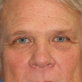 58 year old man who underwent bilateral upper blepharoplasty in office under local anesthesia