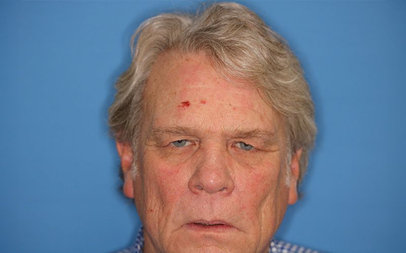 58 year old man who underwent bilateral upper blepharoplasty in office under local anesthesia