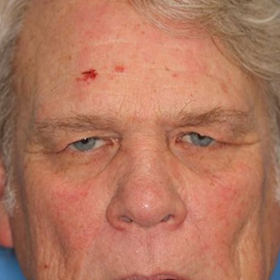 58 year old man who underwent bilateral upper blepharoplasty in office under local anesthesia