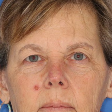 Close up of a woman before eyelid surgery at Carson Williams Facial Plastic Surgery in Leawood, KS