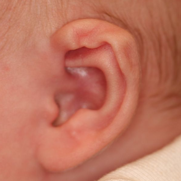 Close up of an infant's ear before EarWell Infant Ear Molding at Carson Williams Facial Plastic Surgery in Leawood, KS