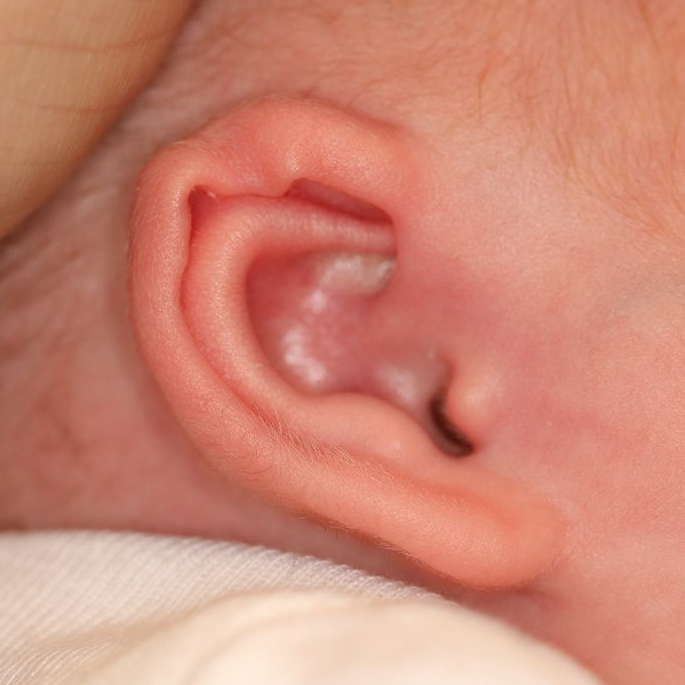 Close up of an infant's ear before EarWell Infant Ear Molding at Carson Williams Facial Plastic Surgery in Leawood, KS