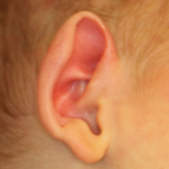 Close up of an infant's ear before EarWell Infant Ear Molding at Carson Williams Facial Plastic Surgery in Leawood, KS