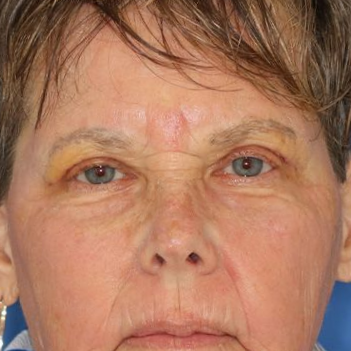 Close up of a woman after eyelid surgery at Carson Williams Facial Plastic Surgery in Leawood, KS
