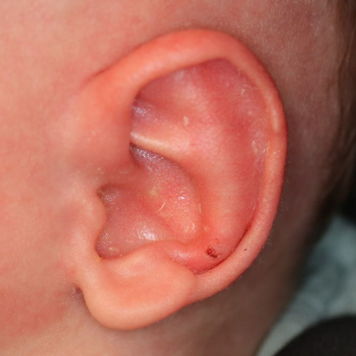 Close up of an infant's ear after EarWell Infant Ear Molding at Carson Williams Facial Plastic Surgery in Leawood, KS