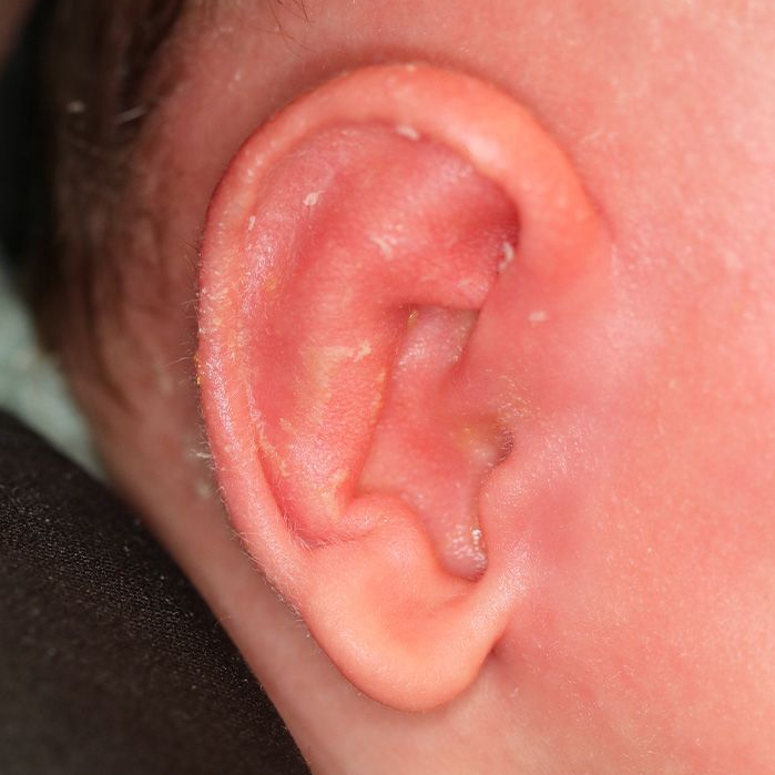 Close up of an infant's ear after EarWell Infant Ear Molding at Carson Williams Facial Plastic Surgery in Leawood, KS