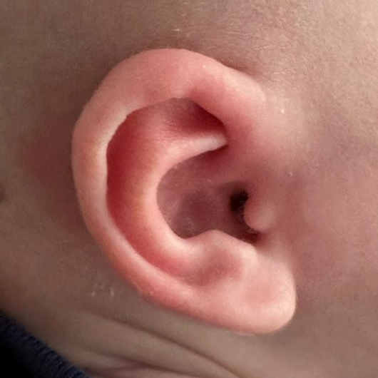 Close up of an infant's ear after EarWell Infant Ear Molding at Carson Williams Facial Plastic Surgery in Leawood, KS
