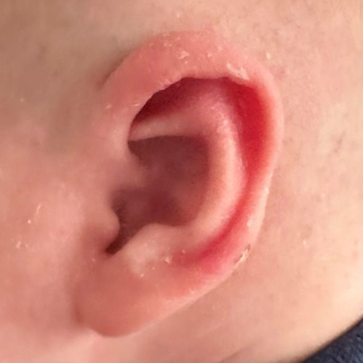 Close up of an infant's ear after EarWell Infant Ear Molding at Carson Williams Facial Plastic Surgery in Leawood, KS