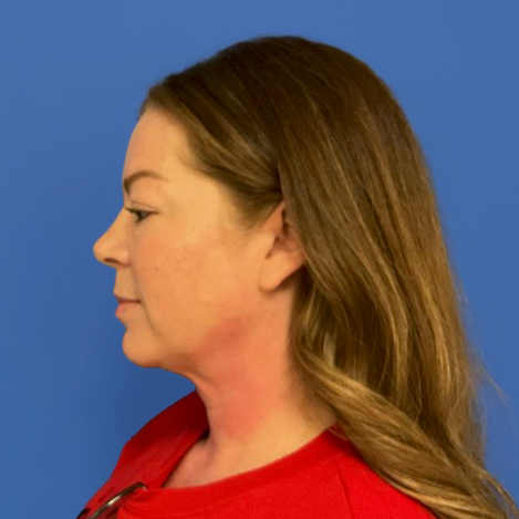 43 year old female facing to the left in front of a blue background before surgery