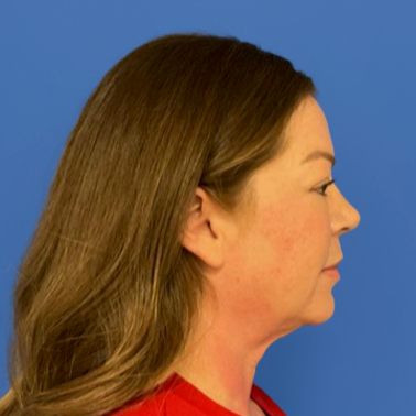 43 year old female facing to the right in front of a blue background before surgery