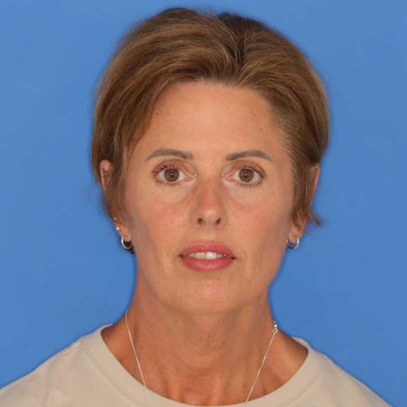 55 year old woman before facelift surgery at Carson Williams MD Facial Plastic Surgery