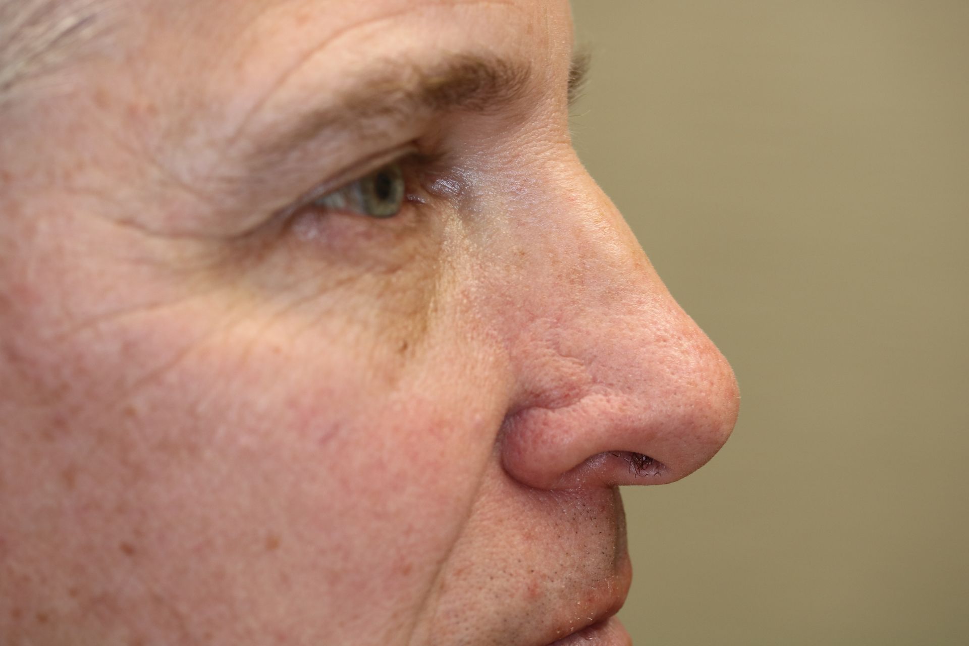 A close up of a man 's nose and eye who underwent Mohs Surgery in Leawood KS