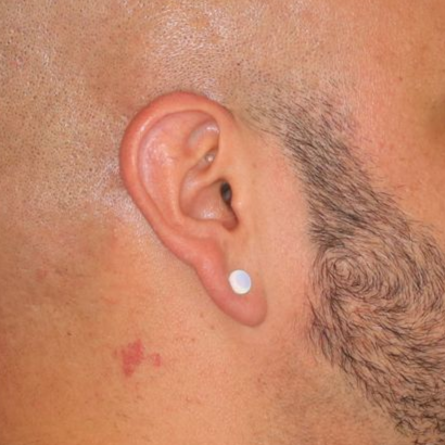 Close up of a person before earlobe repair at Carson Williams Facial Plastic Surgery in Leawood, KS