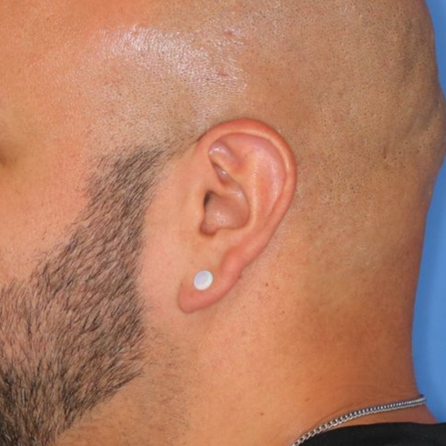 Close up of a person before earlobe repair at Carson Williams Facial Plastic Surgery in Leawood, KS