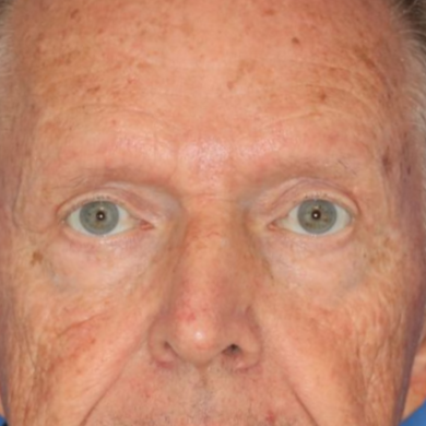 Man posing in front of a blue background after healing from a blepharoplasty