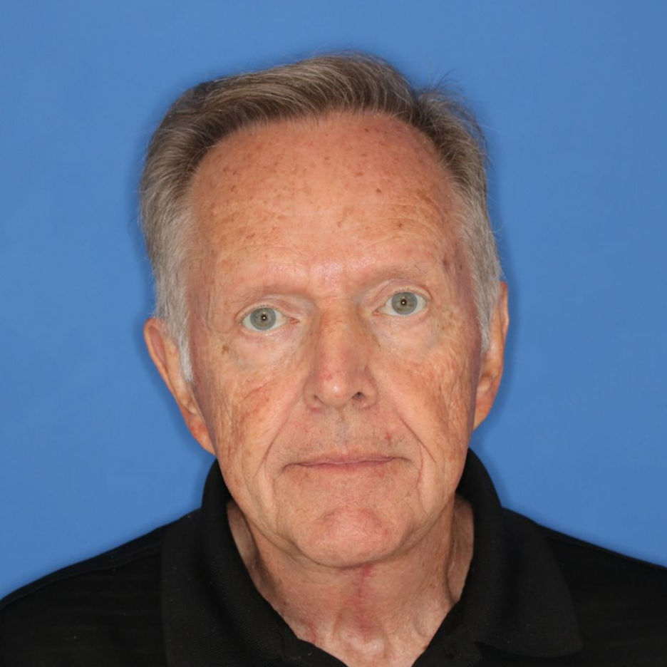 Man posing in front of a blue background after healing from a blepharoplasty