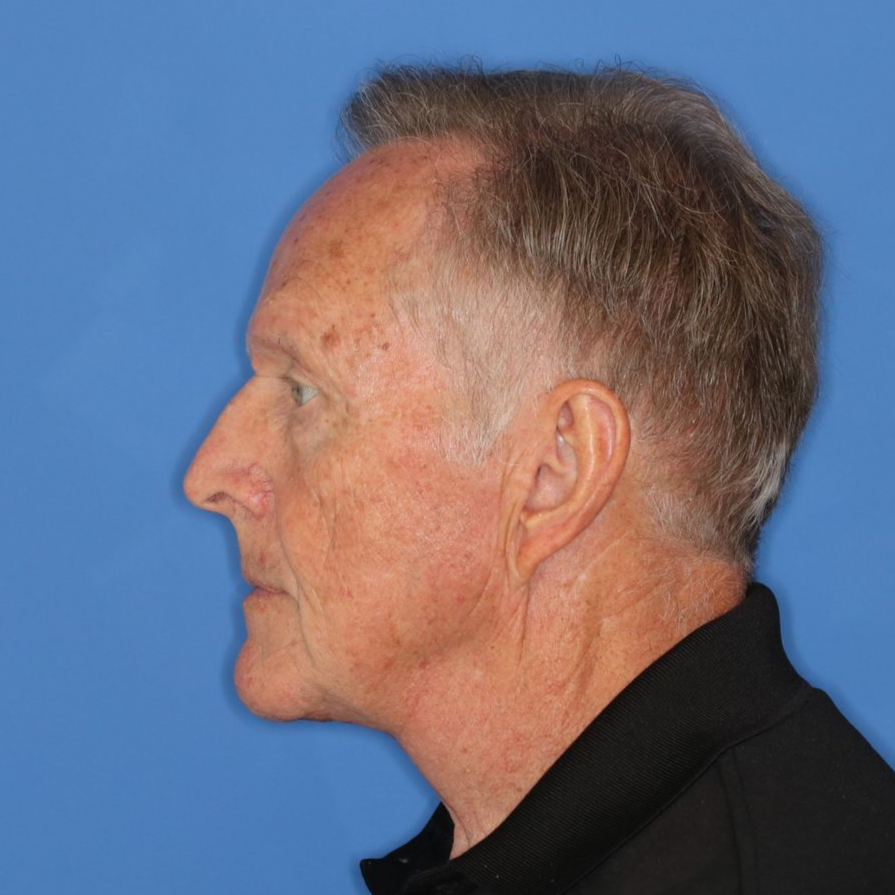 Man facing to the left after fully recovered from surgery