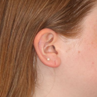Close up of a person before earlobe repair at Carson Williams Facial Plastic Surgery in Leawood, KS