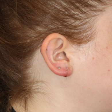 Close up of a person after earlobe repair at Carson Williams Facial Plastic Surgery in Leawood, KS