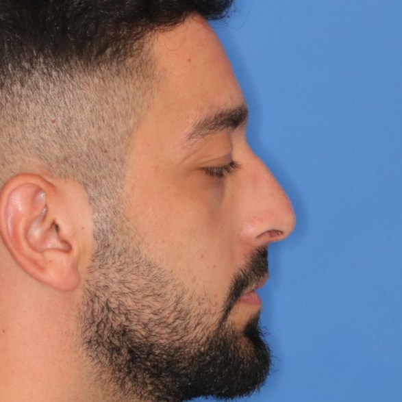 A before picture of a man who underwent Liquid Rhinoplasty at Carson Williams MD Facial Plastic Surgery in Leawood, KS