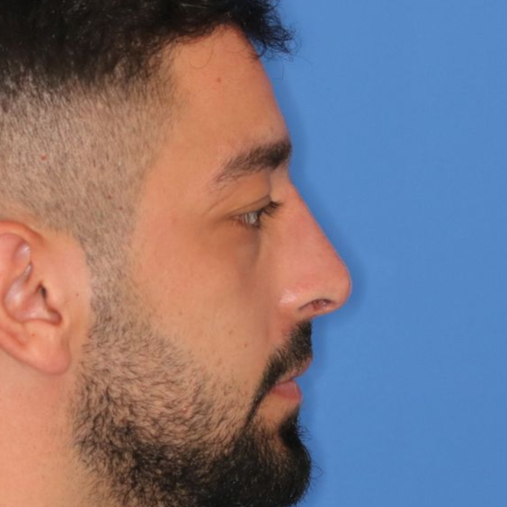 An after picture of a man who underwent Liquid Rhinoplasty at Carson Williams MD Facial Plastic Surgery in leawood, KS