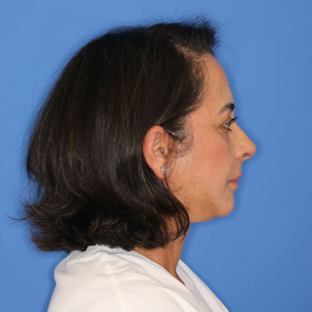 55 year old female underwent deep plane face and neck lift posing on a blue background