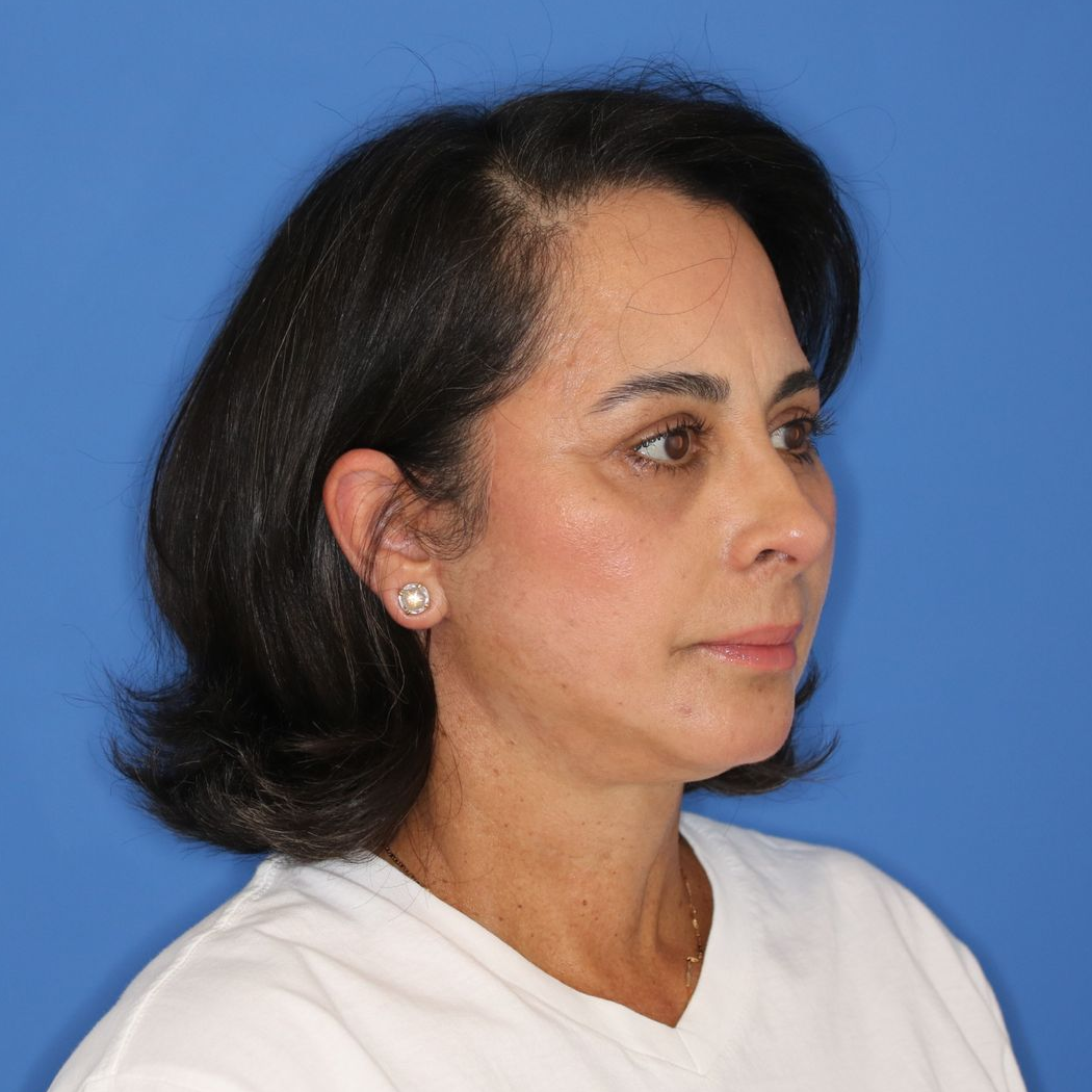 55 year old female underwent deep plane face and neck lift posing for a after photo on a blue background