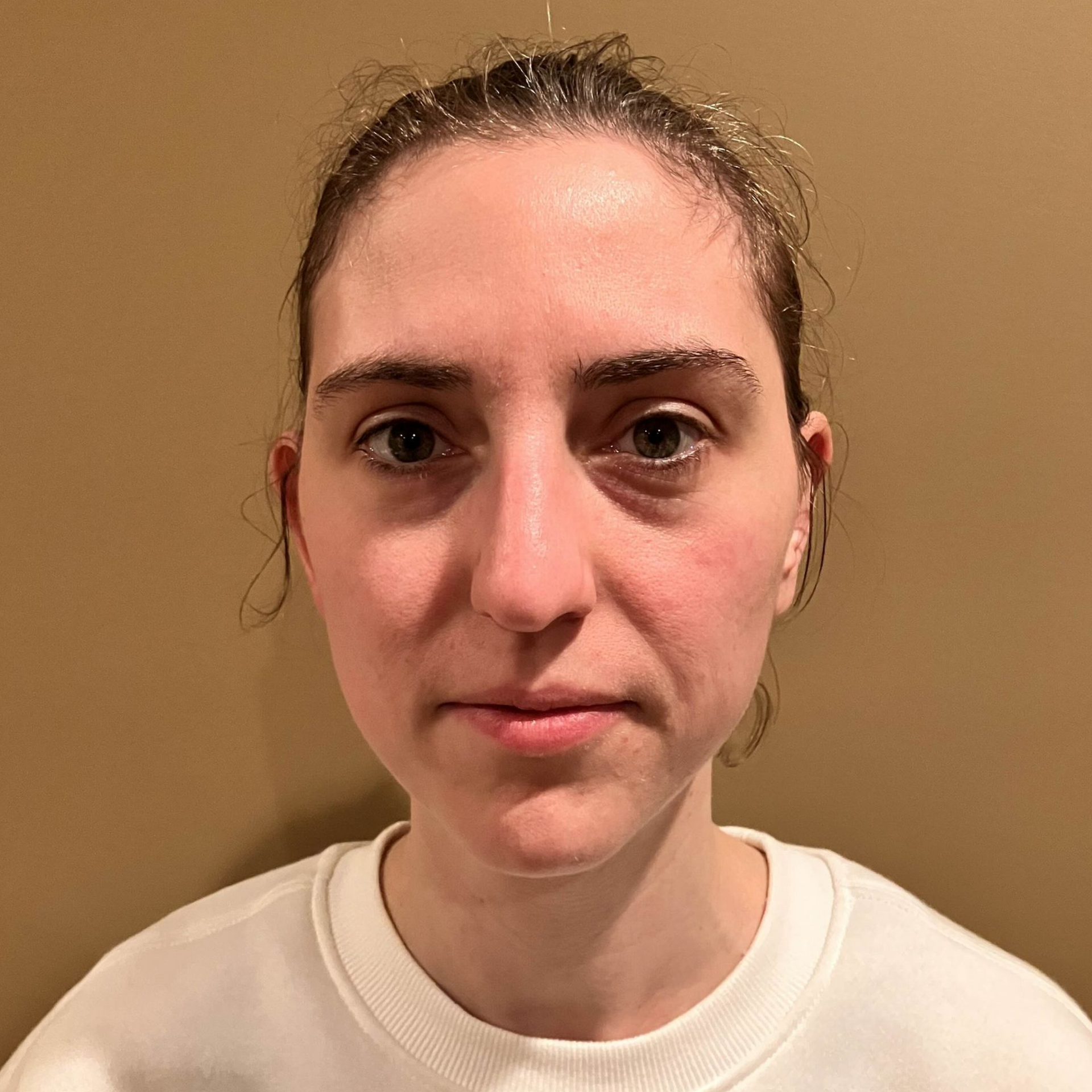 Before Rhinoplasty at Carson Williams, MD Facial Plastic Surgery in Leawood, KS