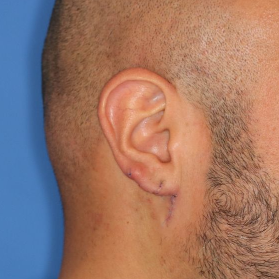 Close up of a person after earlobe repair at Carson Williams Facial Plastic Surgery in Leawood, KS