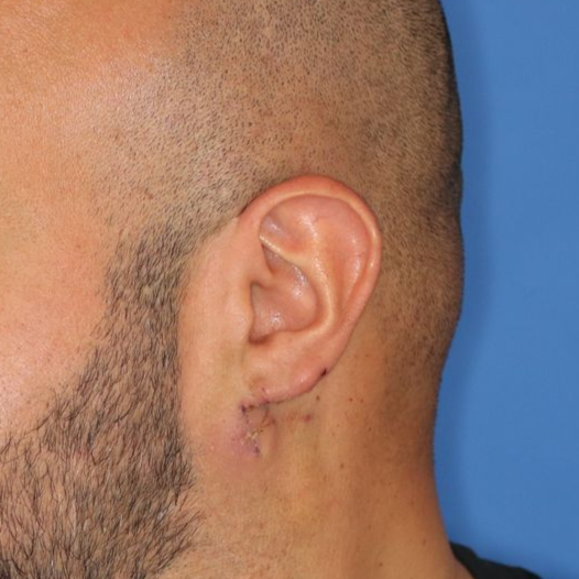 Close up of a person after earlobe repair at Carson Williams Facial Plastic Surgery in Leawood, KS