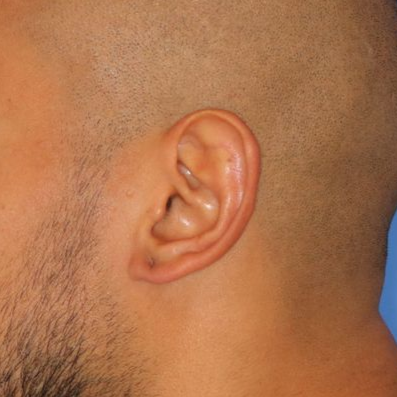 Close up of a person before earlobe repair at Carson Williams Facial Plastic Surgery in Leawood, KS