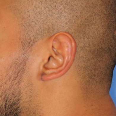 Close up of a person after earlobe repair at Carson Williams Facial Plastic Surgery in Leawood, KS