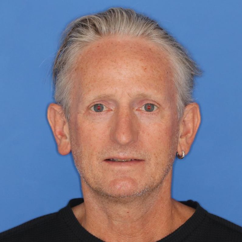 57 year old male after undergoing a rhinoplasty
