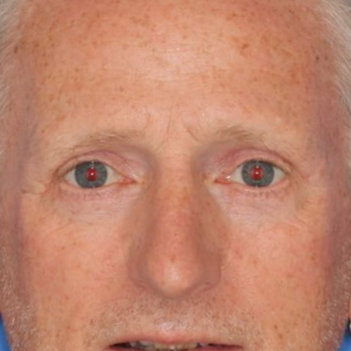 Close up of a 57 year old male in front of a blue background after blepharoplasty