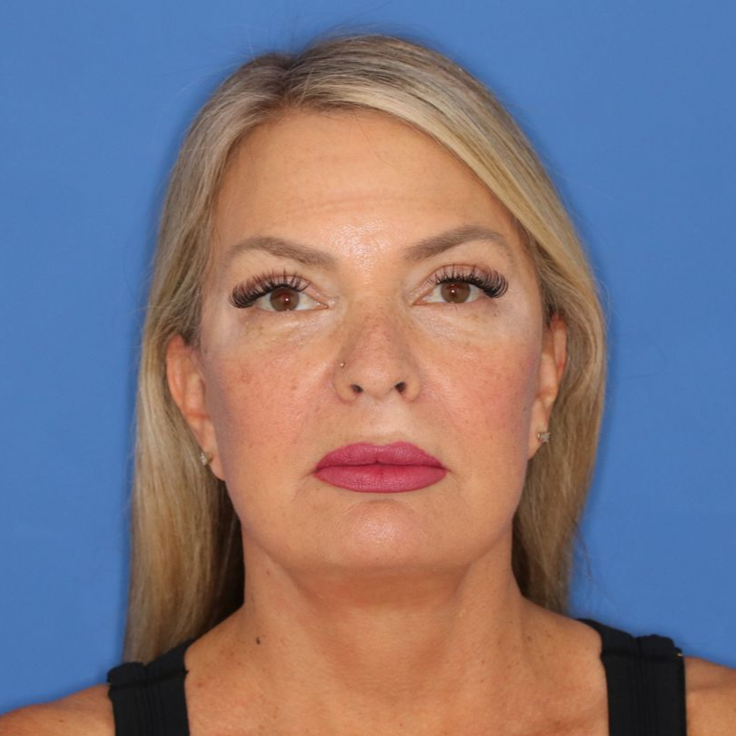 55 year old female underwent deep plane facelift, deep neck lift, upper blepharoplasty and lower blepharoplasty at Carson Williams Facial Plastic Surgery.